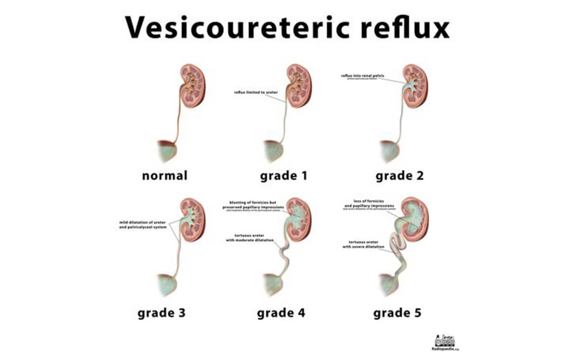 Vesico Ureteric reflux Vesico Ureteric Ureteric Junction Obstructio